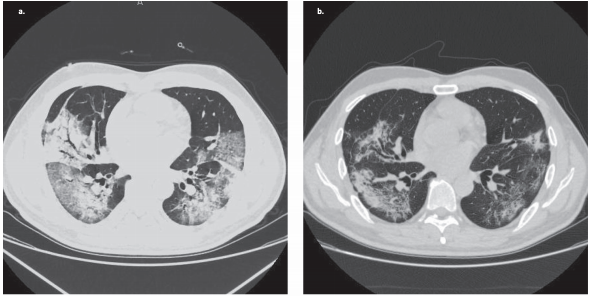 Bevacizumab treatment beneficial for patients with severe COVID-19